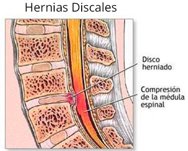 hernias discales
