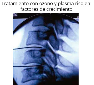 hernias discales 1